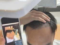 -碧莲盛·不剃发植发