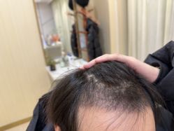 -碧莲盛·不剃发植发