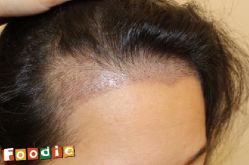 -大麦微针植发丨全国连锁