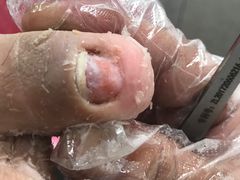 -乐泰亮甲灰指甲(龙城店)