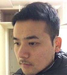 -碧莲盛·不剃发植发