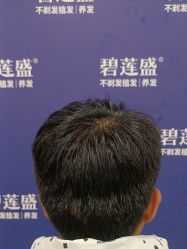 -碧莲盛·不剃发植发