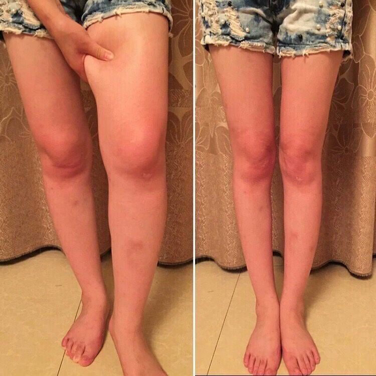 腿部塑形