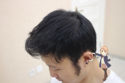 -大麦微针植发丨全国连锁