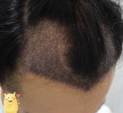 -大麦微针植发丨全国连锁