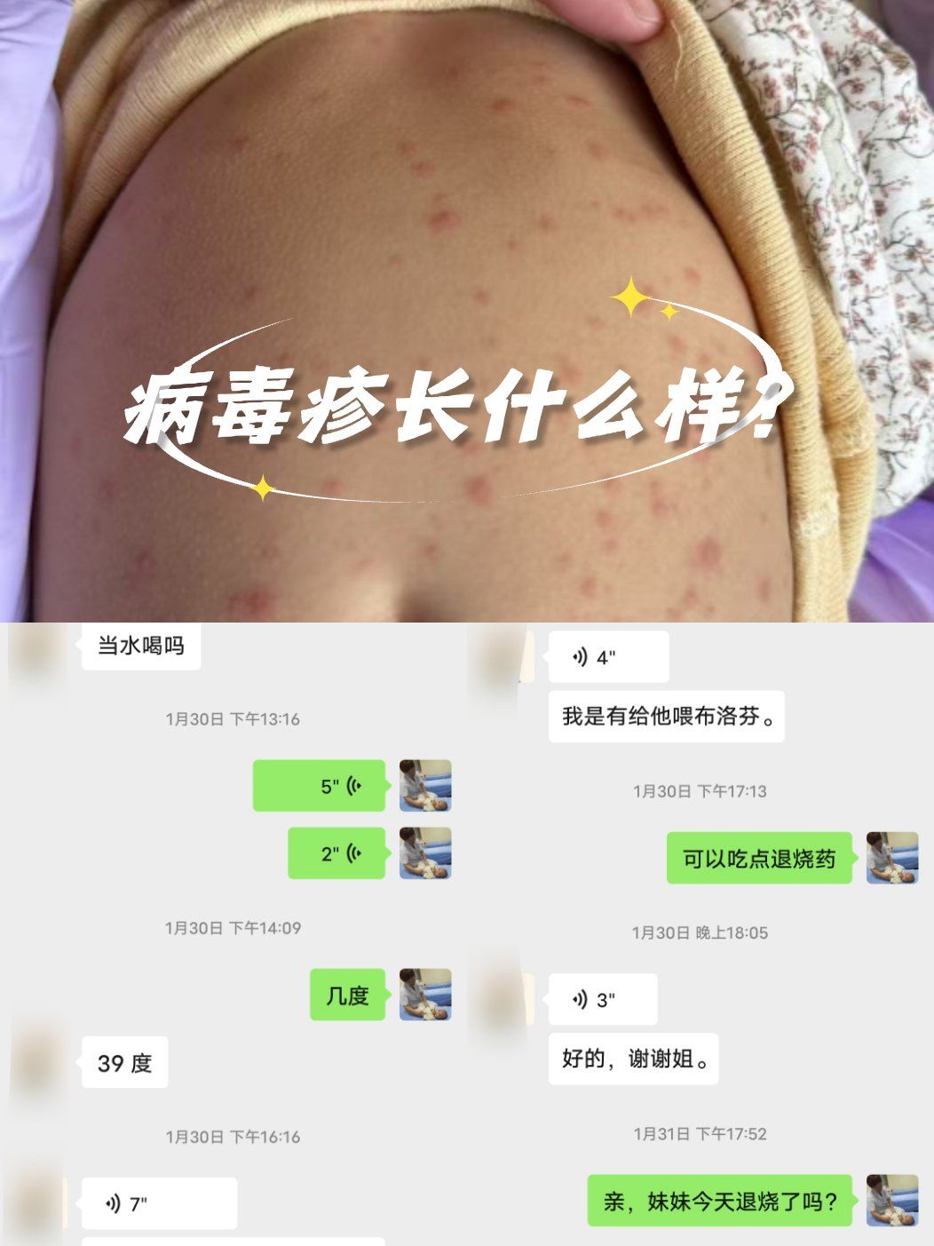 病毒疹长啥样?如何鉴别