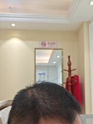 -碧莲盛·不剃发植发