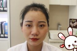 -大麦微针植发丨全国连锁