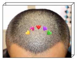 -大麦微针植发全国连锁