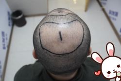 -大麦微针植发丨全国连锁