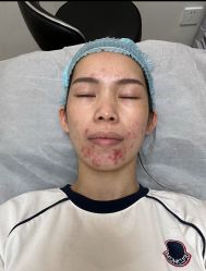 体验前-深圳米兰柏羽医疗美容医院