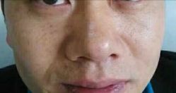 -北京美痣堂古方祛痣斑疣瘊