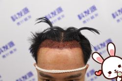 -大麦微针植发丨全国连锁