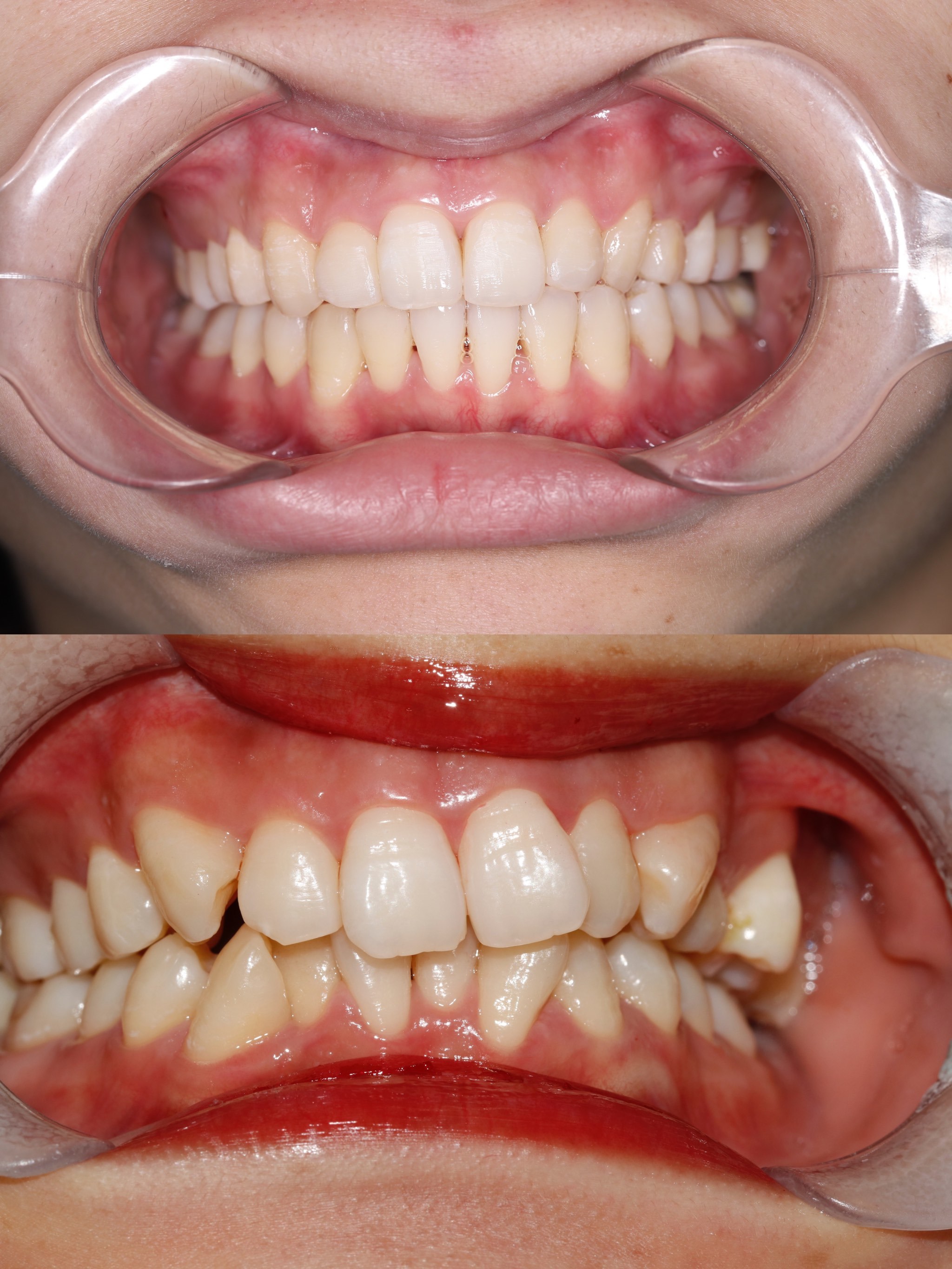 感谢牙白兔口腔给我妈生牙!