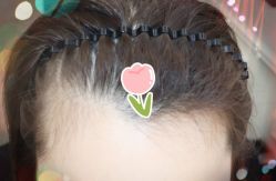 -大麦微针植发全国连锁