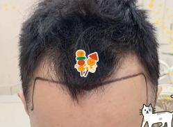 -大麦微针植发全国连锁