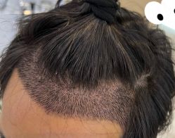 -大麦微针植发全国连锁