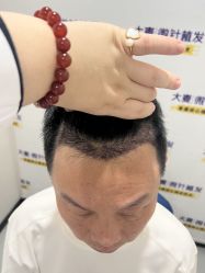 体验后-大麦微针植发全国连锁