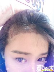 -大麦微针植发全国连锁