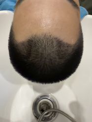 -大麦微针植发全国连锁