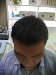 -大麦微针植发全国连锁