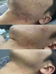 -瑶芳清颜草本祛痘