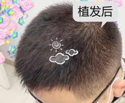 -大麦微针植发全国连锁