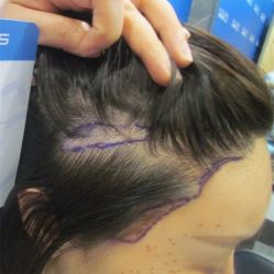 -碧莲盛不剃发植发