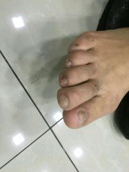 -德哥灰指甲脚气甲沟炎跖疣护理