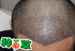 -大麦微针植发丨全国连锁