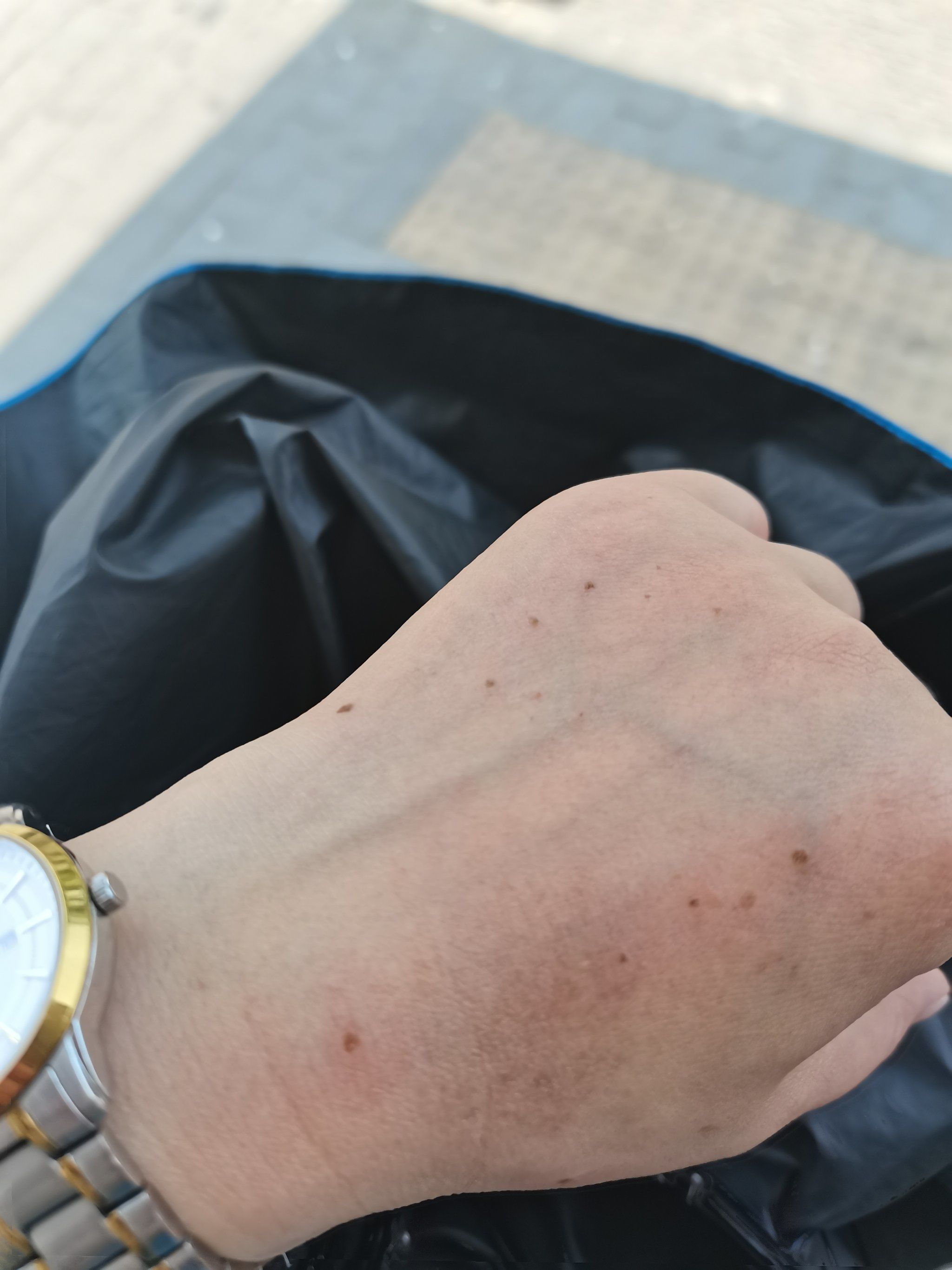 0元玩转这座城 最近发现手背上长了几颗很小的凸起,应该就是扁平疣
