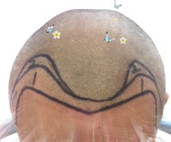 -大麦微针植发全国连锁