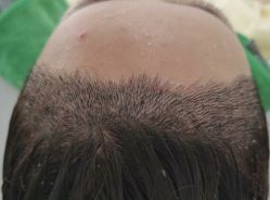 -大麦微针植发全国连锁