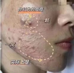 -苗方清颜专业祛痘连锁机构