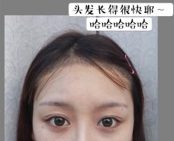 -碧莲盛·不剃发植发