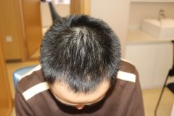 -大麦微针植发丨全国连锁