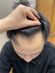 -大麦微针植发全国连锁