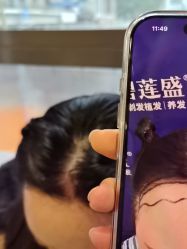 -碧莲盛·不剃发植发