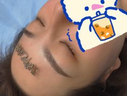 体验后-郡艺医疗美容·微整·眼鼻吸脂