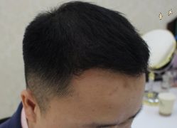 -大麦微针植发全国连锁