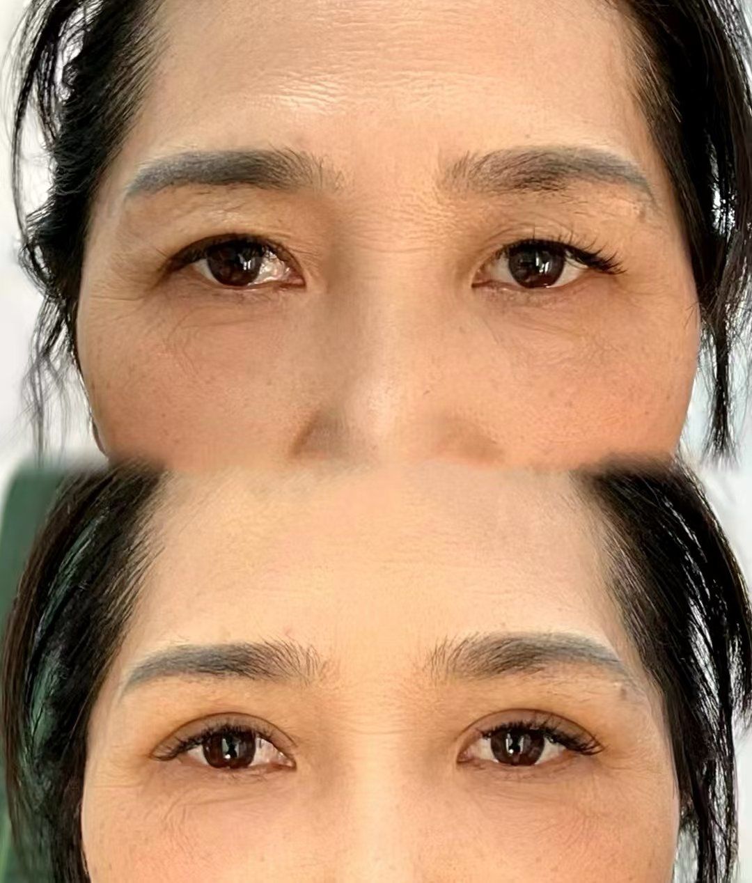 提眉三个月效果