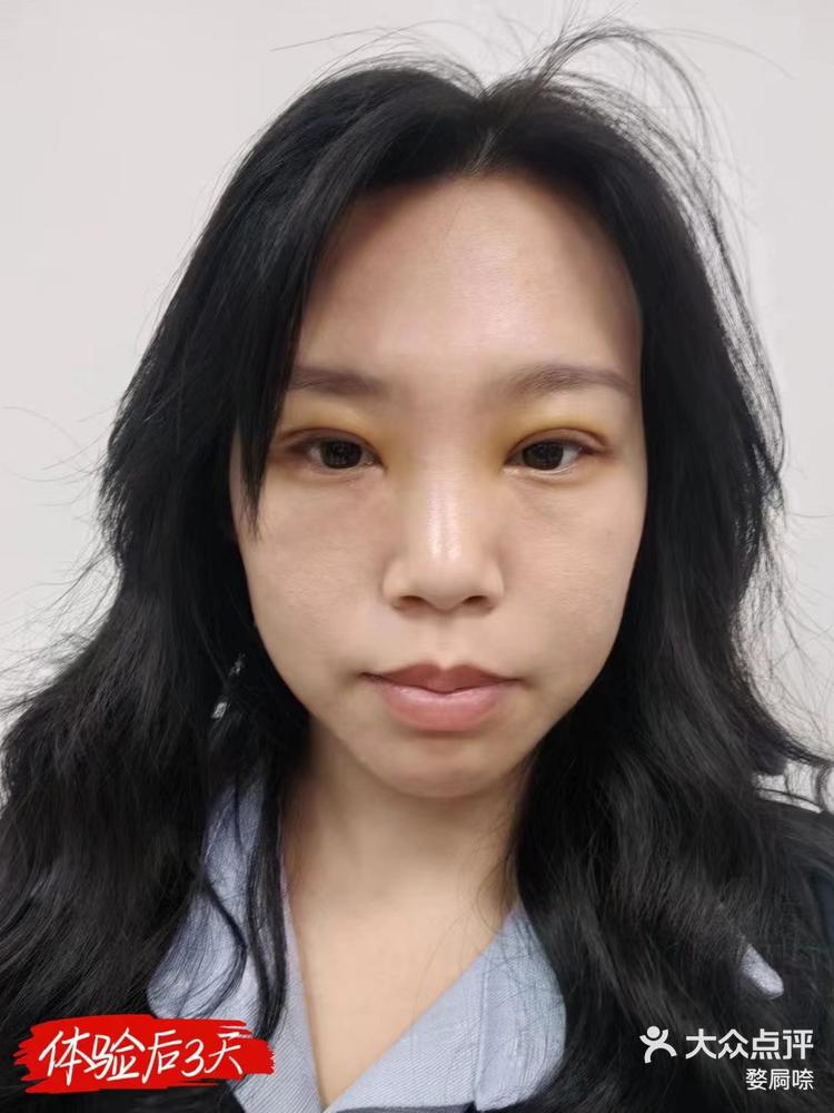 【艺星星美眼】术后7天真实效果反馈!