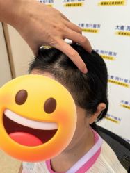 -大麦微针植发全国连锁