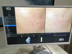 -苑苑vbeauty科技美容SPA