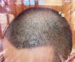 -大麦微针植发全国连锁