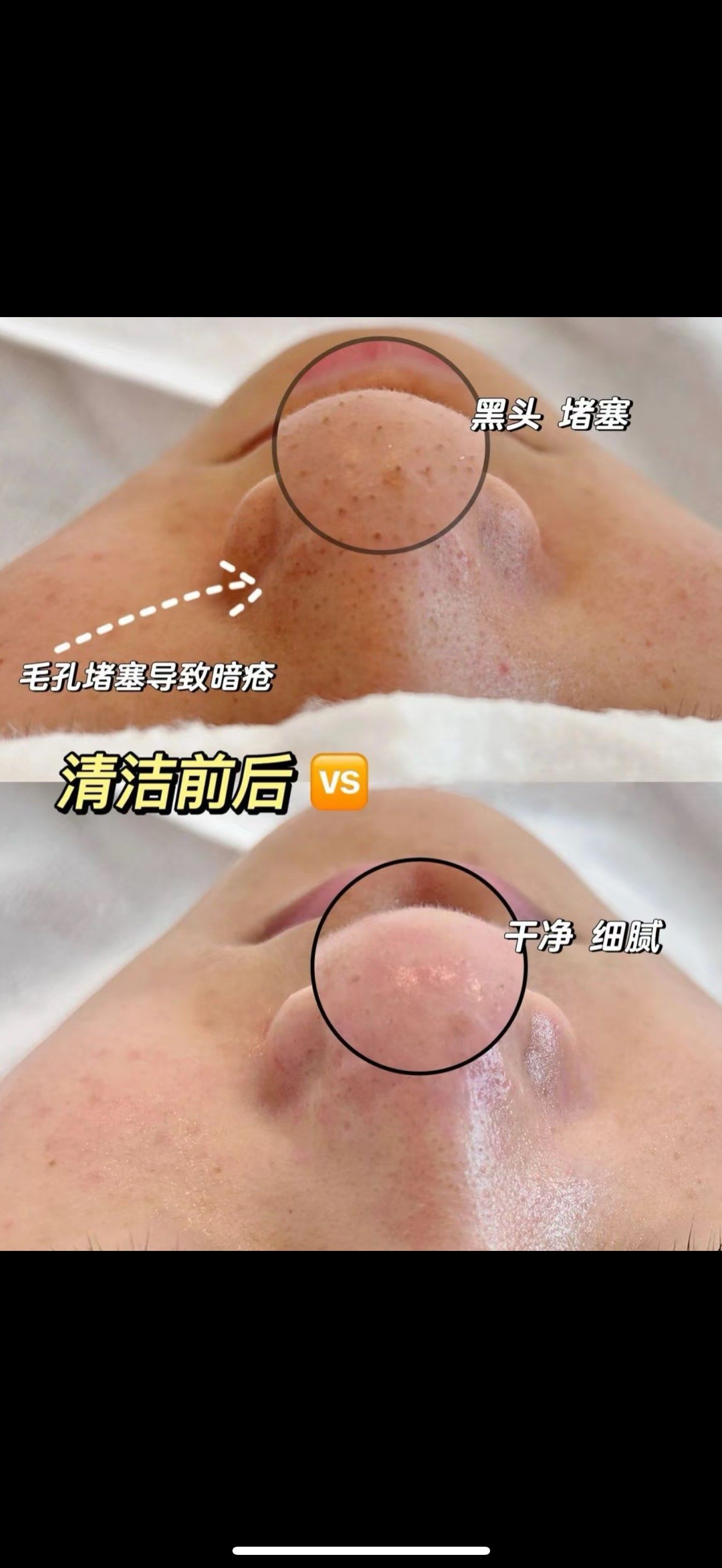 毛孔深层净化 ✨