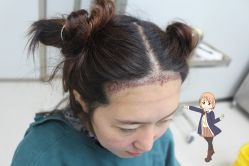 -大麦微针植发丨全国连锁