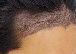 -大麦微针植发全国连锁