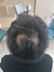 -大麦微针植发丨全国连锁
