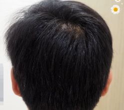 -大麦微针植发丨全国连锁